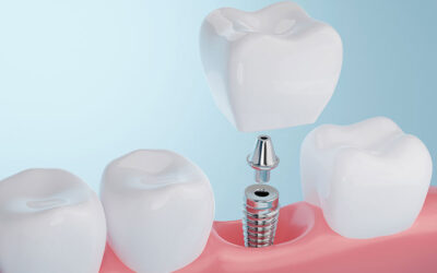 What Are Same Day Dental Implants?