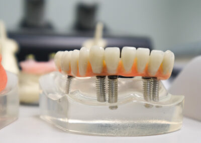 23 dental implants examples close up with shallow focus